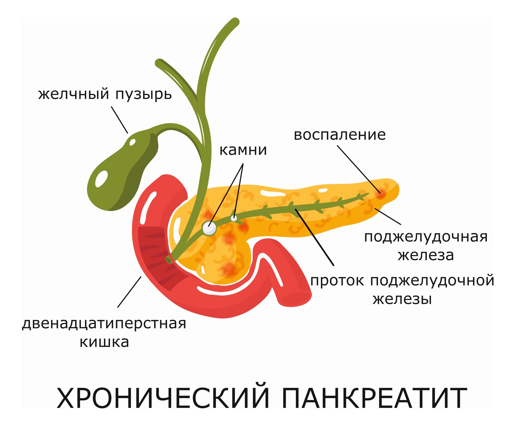 панкреатит и желтый стул