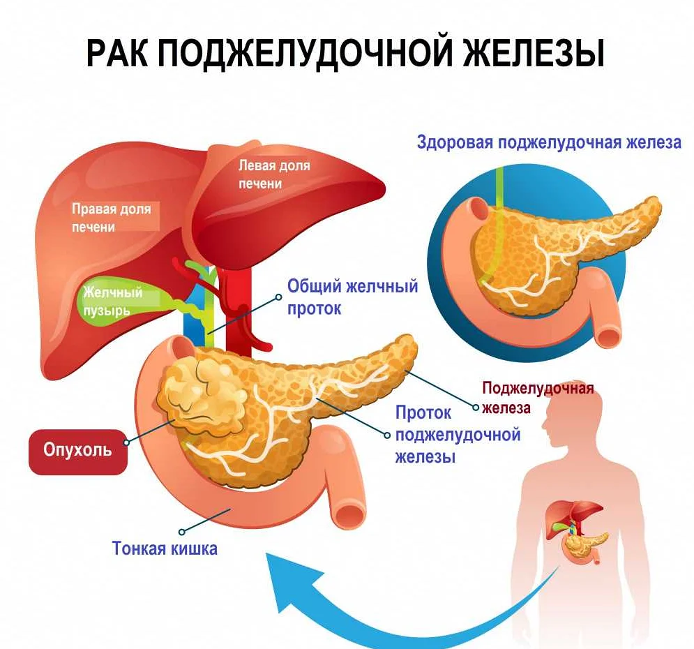 Панкреатит и рак: взаимосвязь и последствия